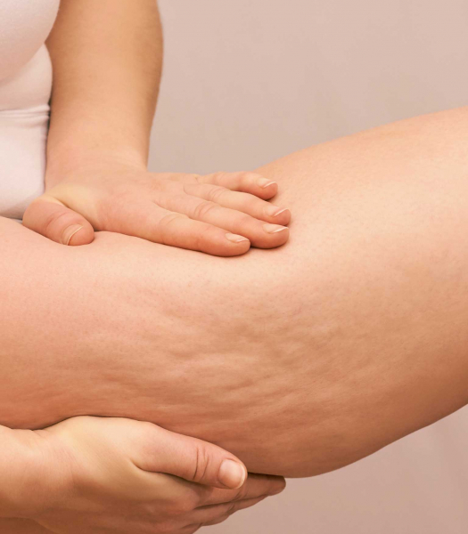 cellulite-problem-news
